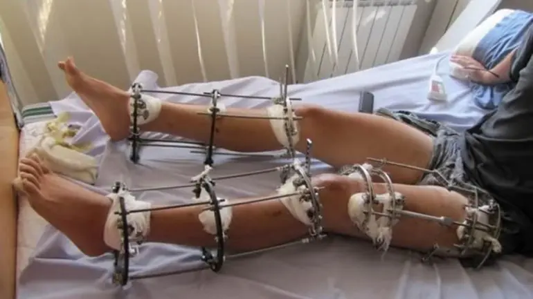 La dolorosa operación para alargar las piernas que gana...