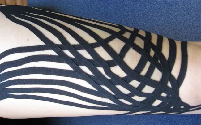 Utilidad del kinesiotaping o vendaje neuromuscular