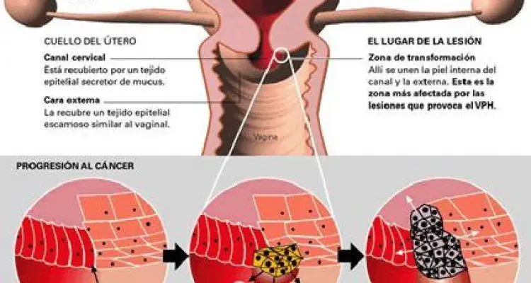 Qué es, y cómo se transmite, el virus del papiloma humano