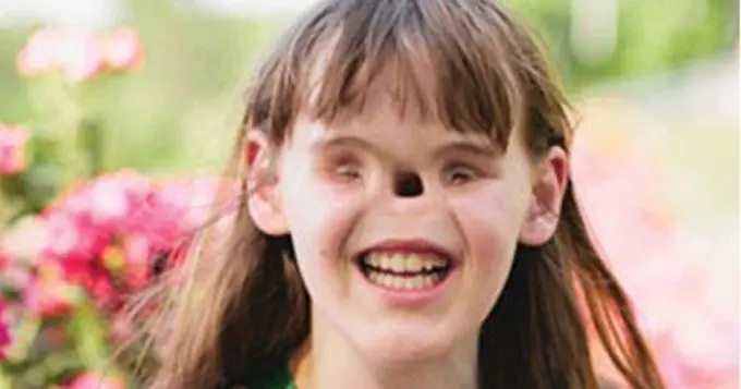 La chica sin nariz y ojos empezó la facultad