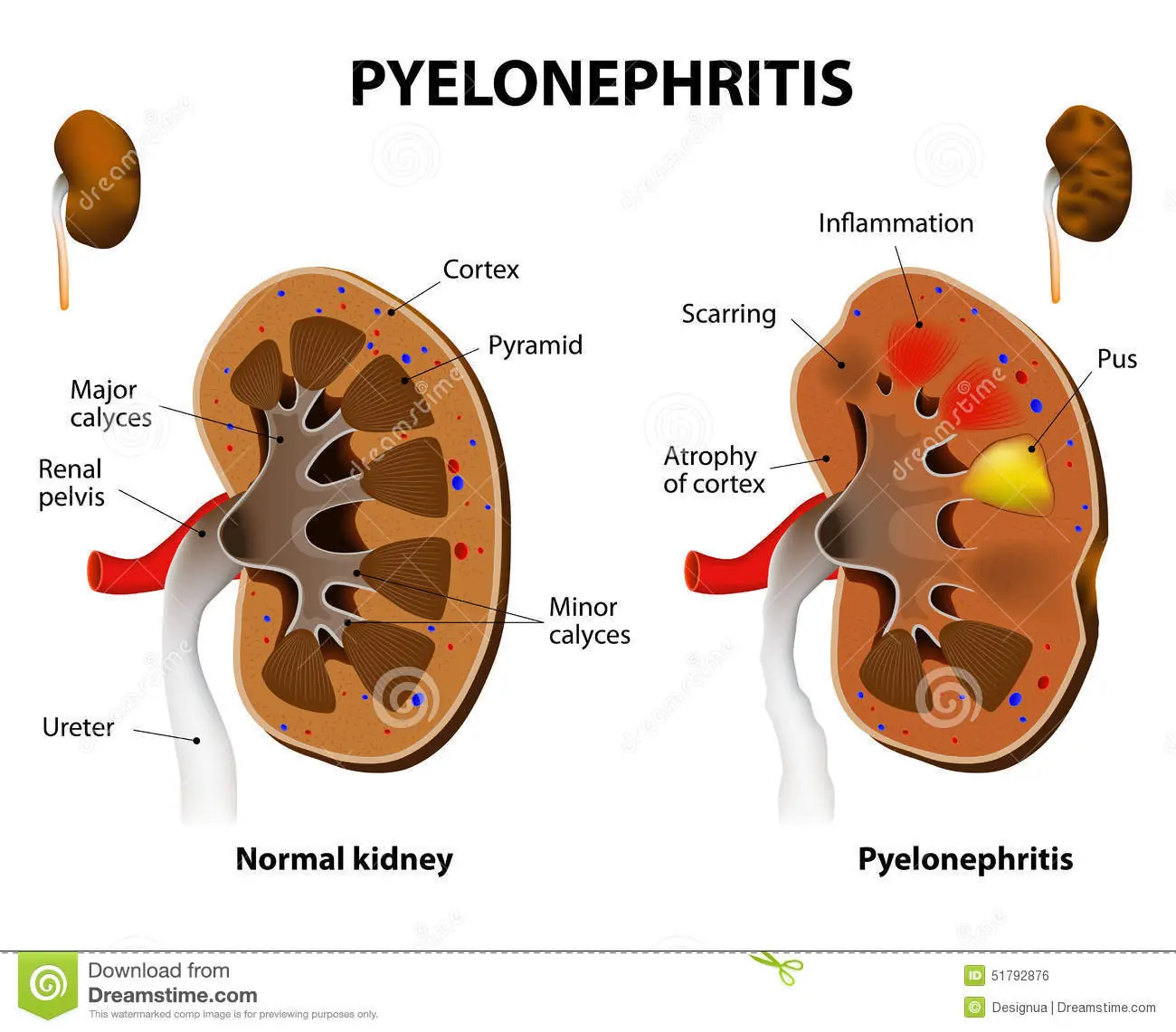 Enfermedad renal