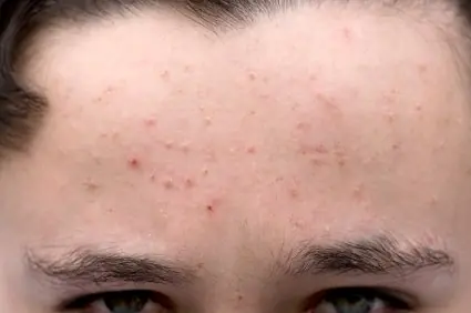Tenes acne? depende donde salga señala otras afecciones