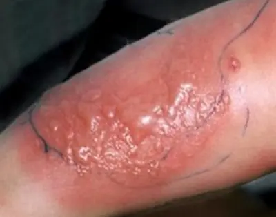 celulitis