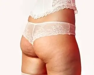 Celulitis