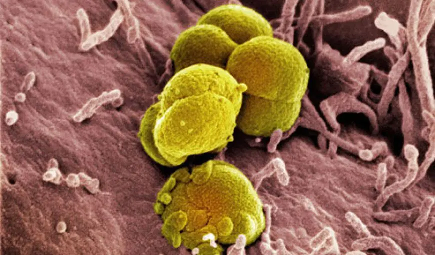 gonorrea