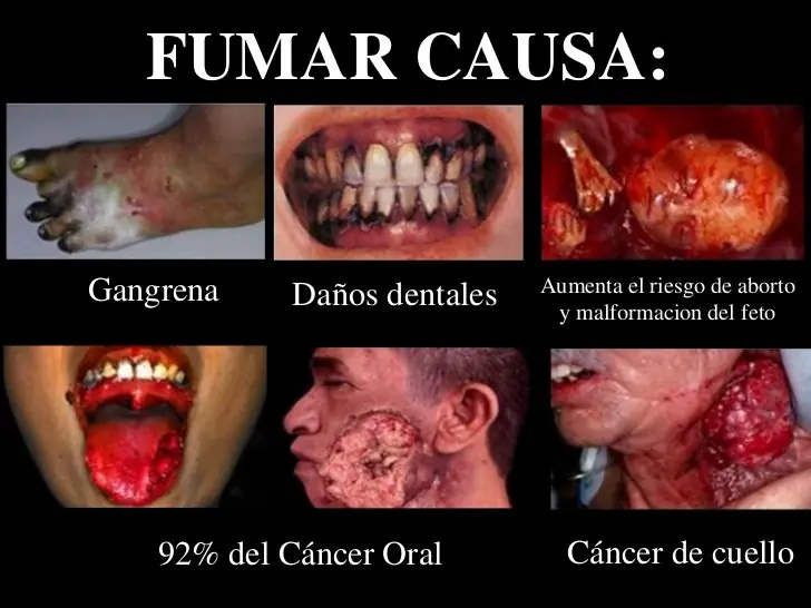 Enfermedades que causa fumar