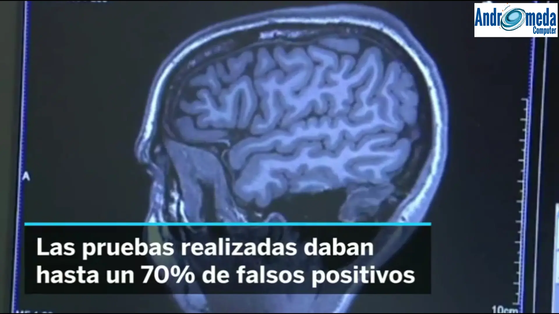 cerebro