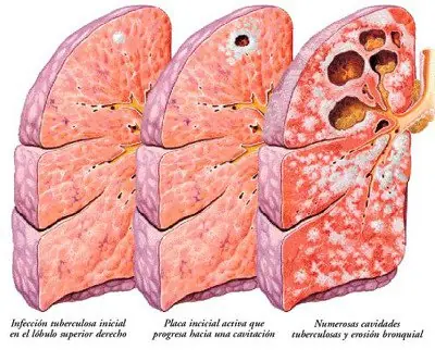 Tuberculosis