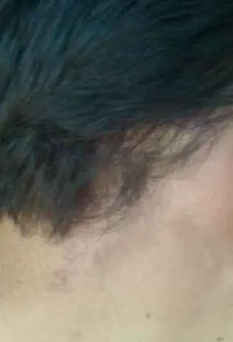 tumor cerebral tumor cerebral