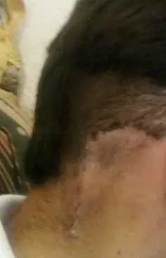 neurinoma del acustico