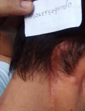tumor cerebral