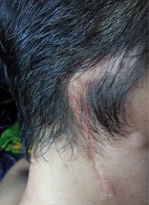 Me operaron la cabeza y asi va mi recuperacion