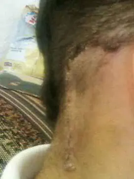 Me operaron la cabeza y asi va mi recuperacion Me operaron la cabeza y asi va mi recuperacion