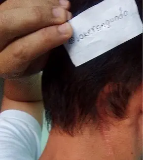 Me operaron la cabeza, así va mi recuperación, certificado