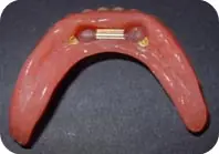 implantes dentales