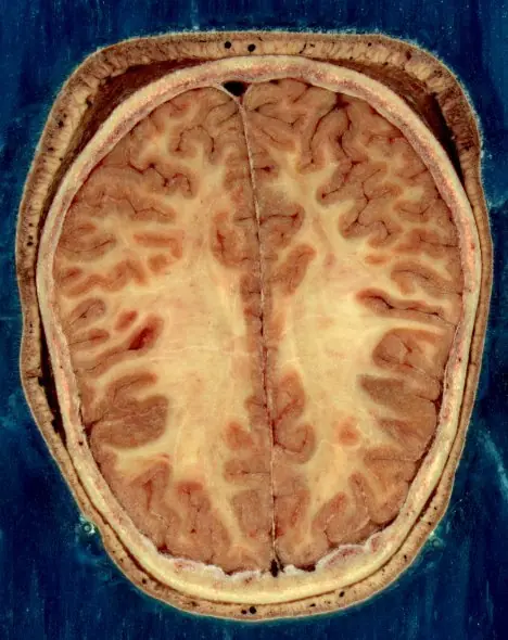 cerebro