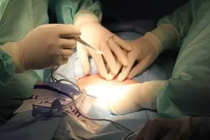 Fimosis Operación (+18)