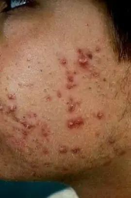 Combatiendo barros y espinillas