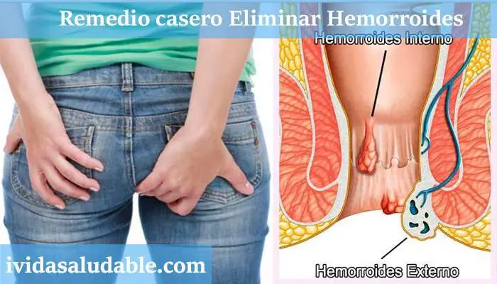 hemorroides