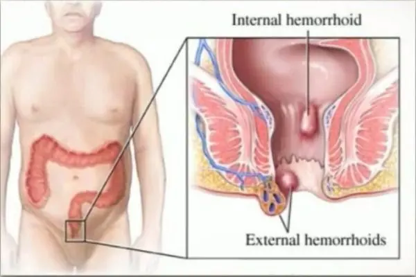 Tengo hemorroides y te lo cuento