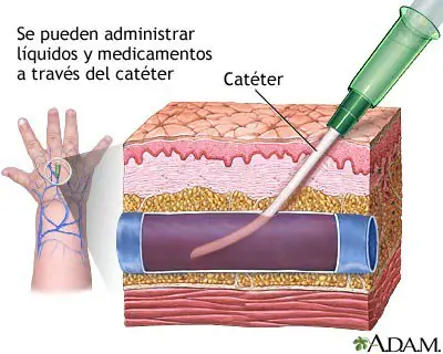 anestesia