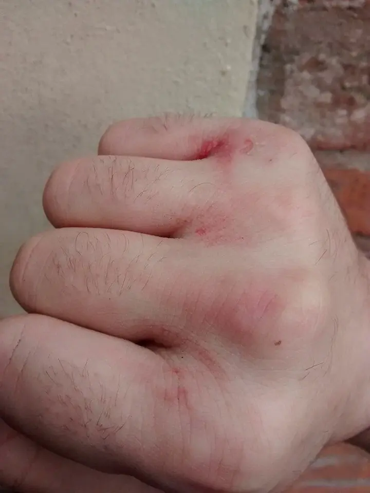 Me operaron de urgencia y me internaron una semana