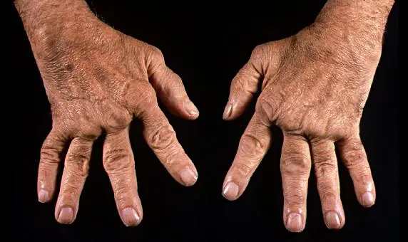 Artritis reumatoide