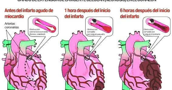 infarto