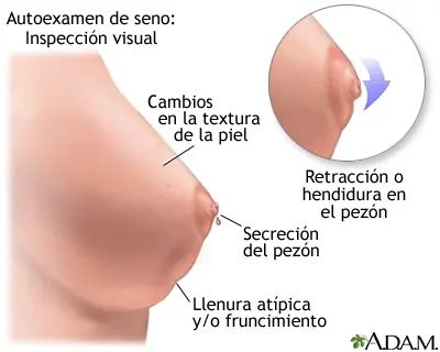 Cómo hacer un examen mamario.