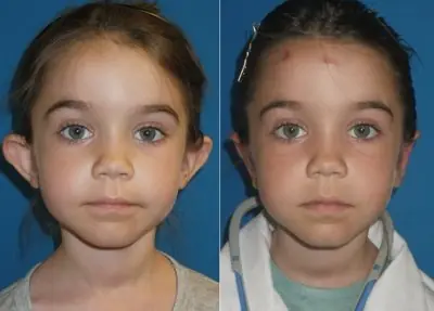 Me hicieron una Otoplastía (cirujia estetica) y te lo cuento