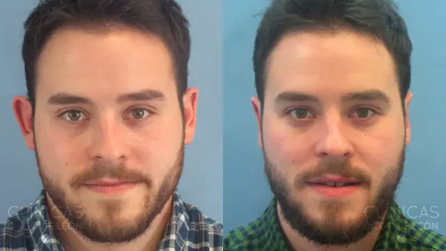 Me hicieron una Otoplastía (cirujia estetica) y te lo cuento