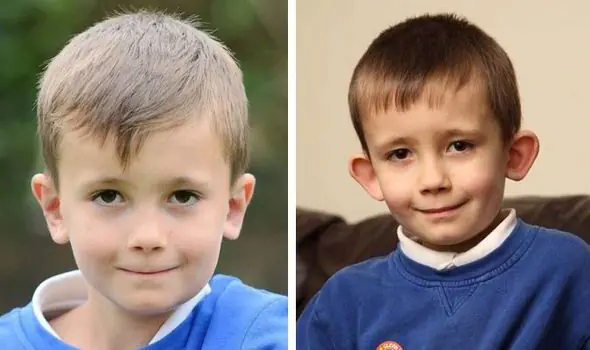 Me hicieron una Otoplastía (cirujia estetica) y te lo cuento