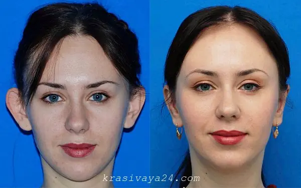 Me hicieron una Otoplastía (cirujia estetica) y te lo cuento