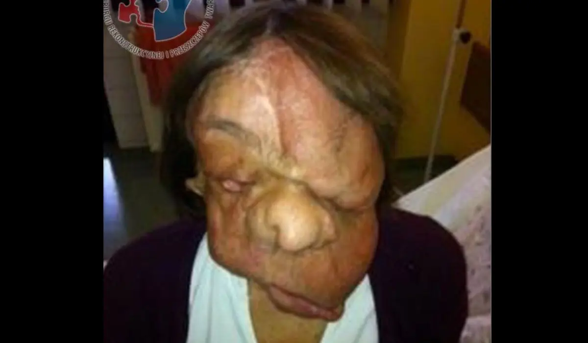 Un tumor facial le desfiguró el rostro, hoy luce increíble