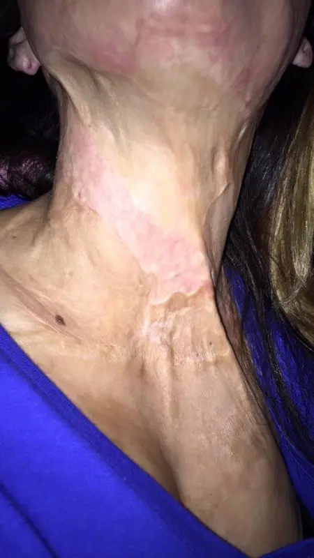 con su cuerpo quemado sigui adelante