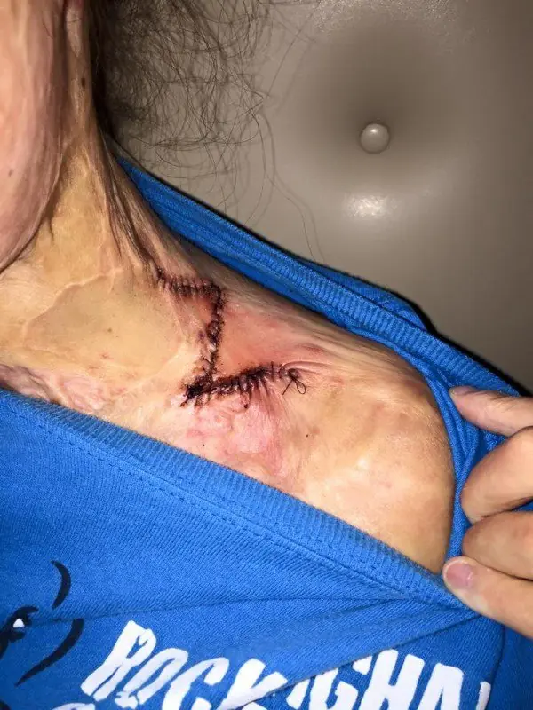 con su cuerpo quemado sigui adelante
