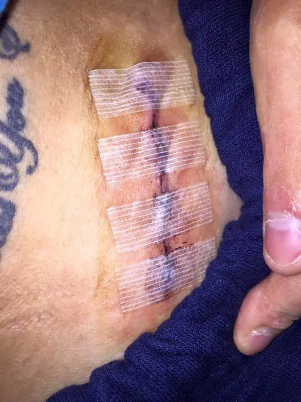 tiene el 80 de su cuerpo quemado pero sigue siendo hermosa