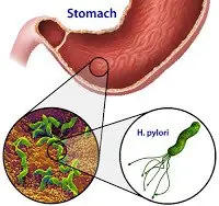 Tratamiento Natural: Helicobacter Pylori