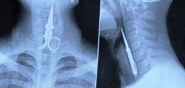 WTF! 16 Radiografías que atormentaron a los médicos