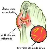 sintomas de la gota en mujeres