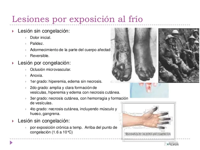 Congelación o quemadura por frío