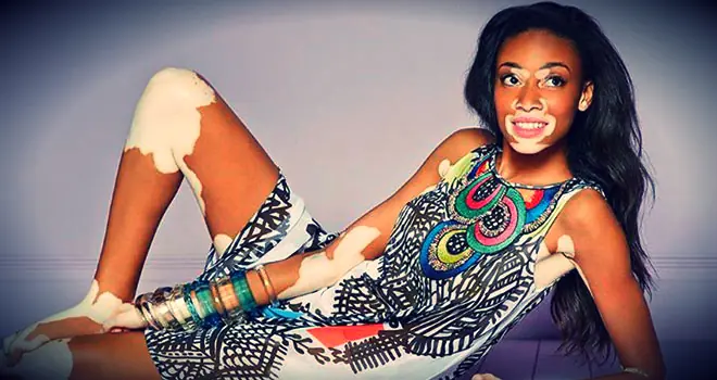 vitiligo