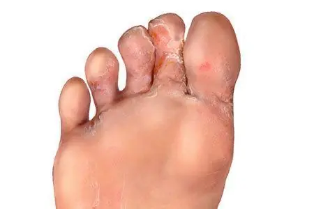 Información que cura: Terbinafina para el hongo de los piés