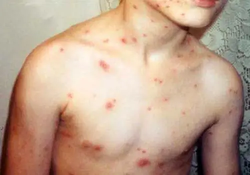 Bioterrorismo