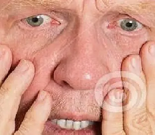Varicocele