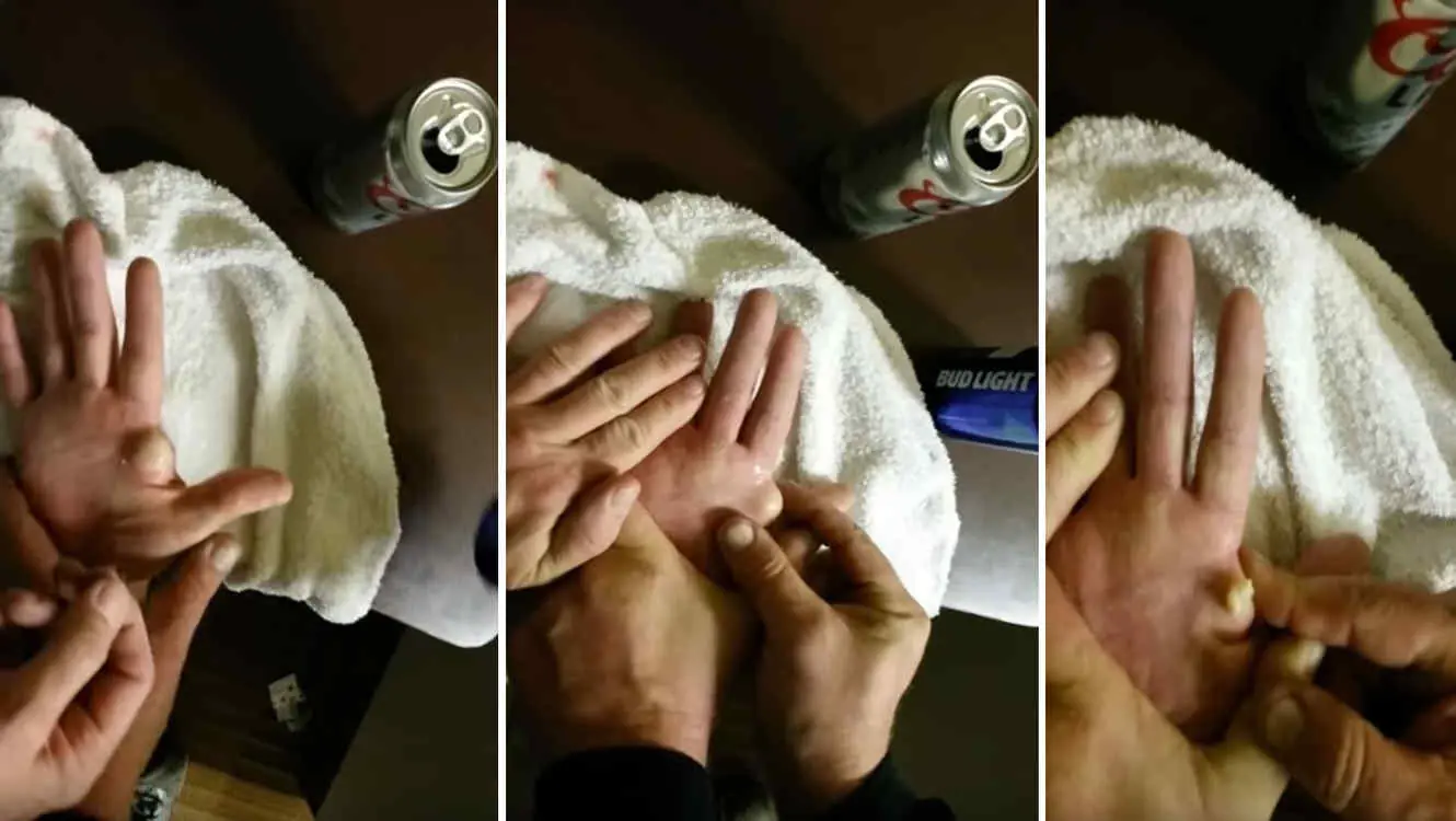 Un hombre se explota un enorme quiste que tiene en su mano