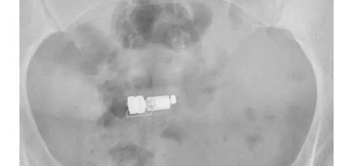 Cuerpos extraños en agujeros humanos: Sorprendente!