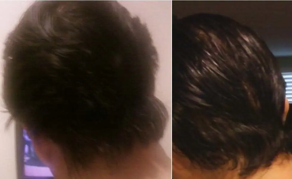 me operaron de un tumor en la cabeza