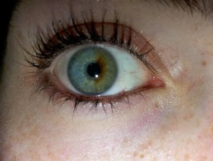 heterocromia