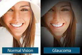 glaucoma definicion